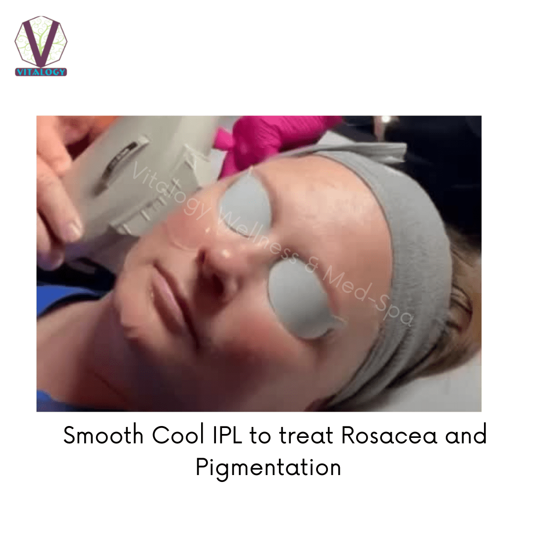 Smooth Cool IPL To Treat Rosacea and Pigmentation