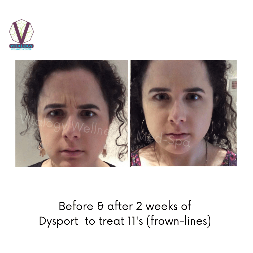 Dysport Before & After