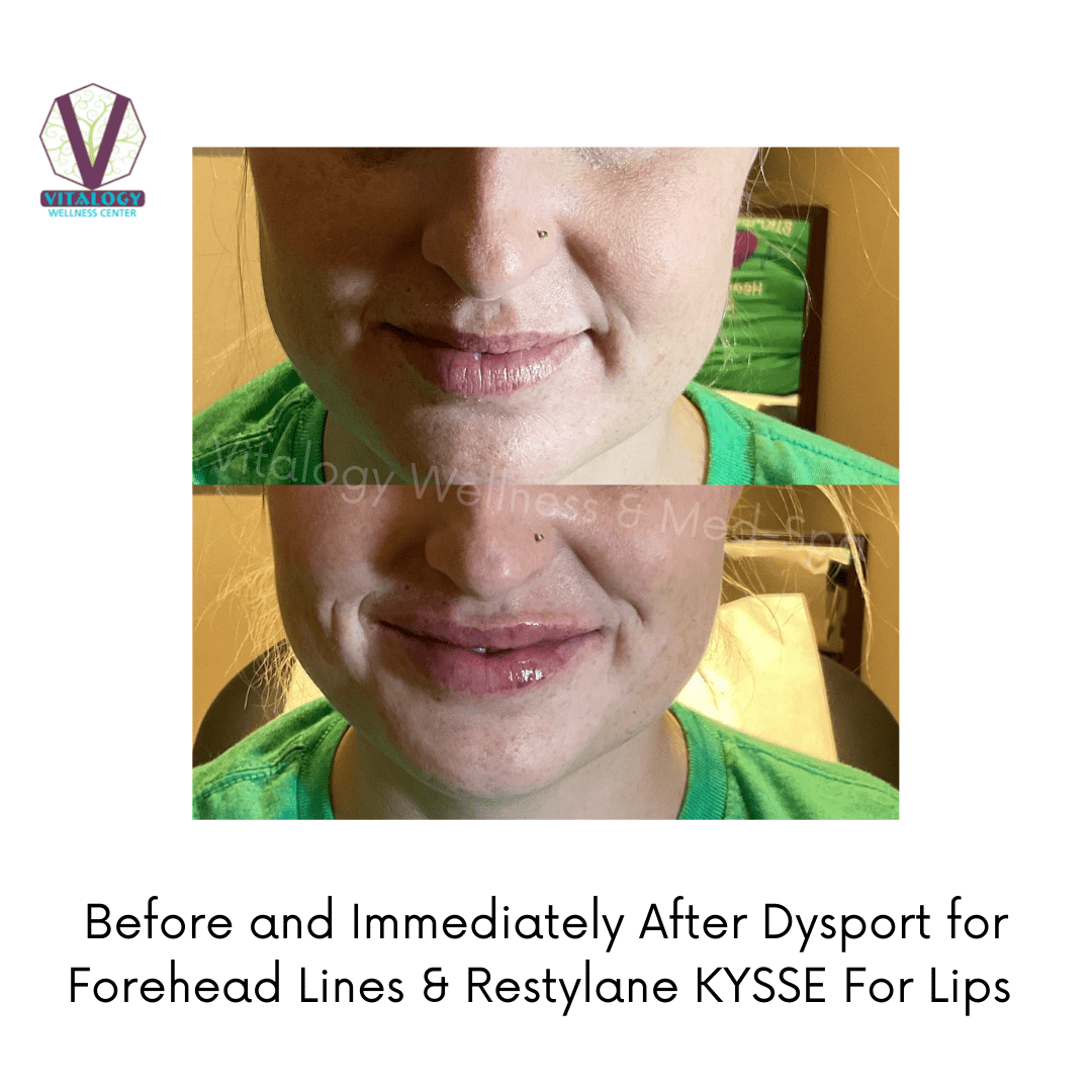 Before and immediately after Restylane KYSSE For Lips By Dr. Farah Sultan at Vitalogy Wellness & Medical Spa in Homewood, Alabama