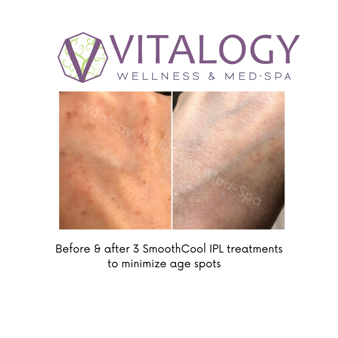 Before & After 3 SmoothCool IPL Treatments To Minimize Age Spots