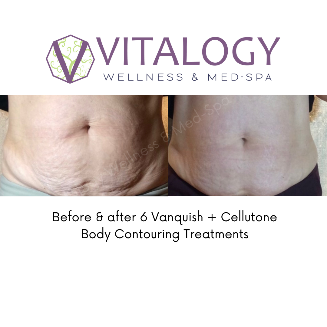 Before & After 6 Vanquish + Cellutone Body Contouring Treatments