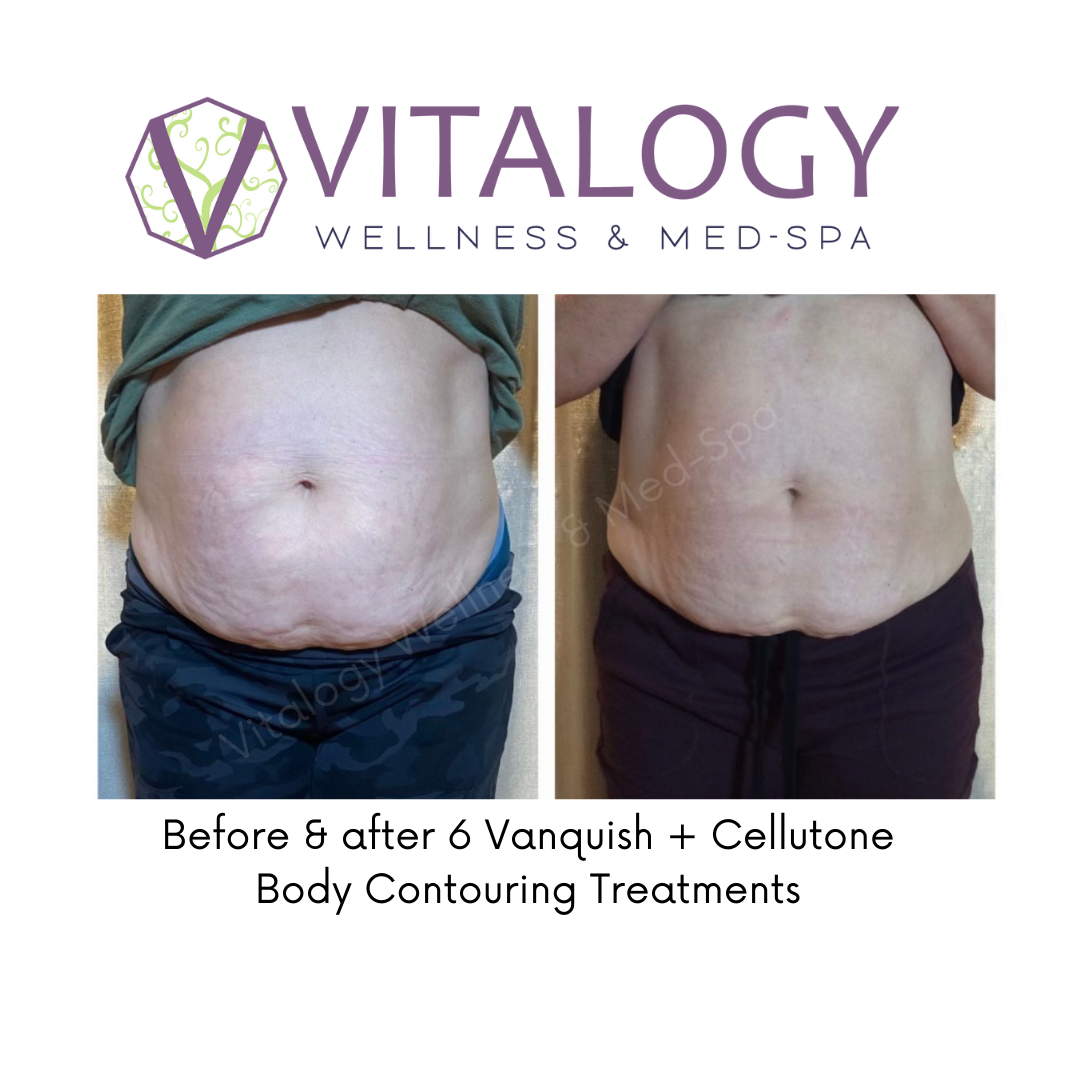 Before & After 6 Vanquish + Cellutone Body Contouring Treatments