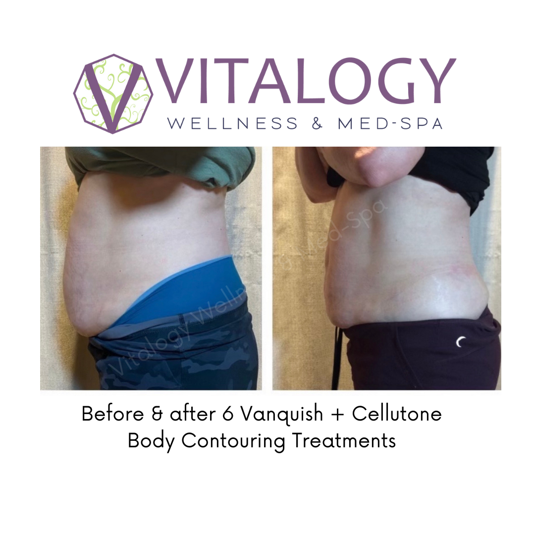 Before & After 6 Vanquish + Cellutone Body Contouring Treatments