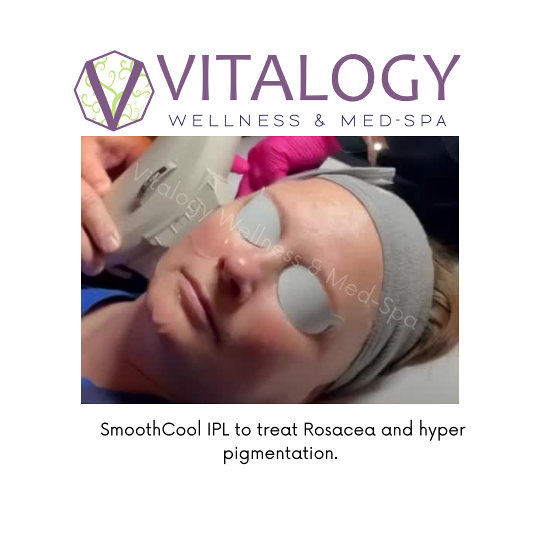 SmoothCool IPL To Treat Rosacea & Hyper-pigmentation