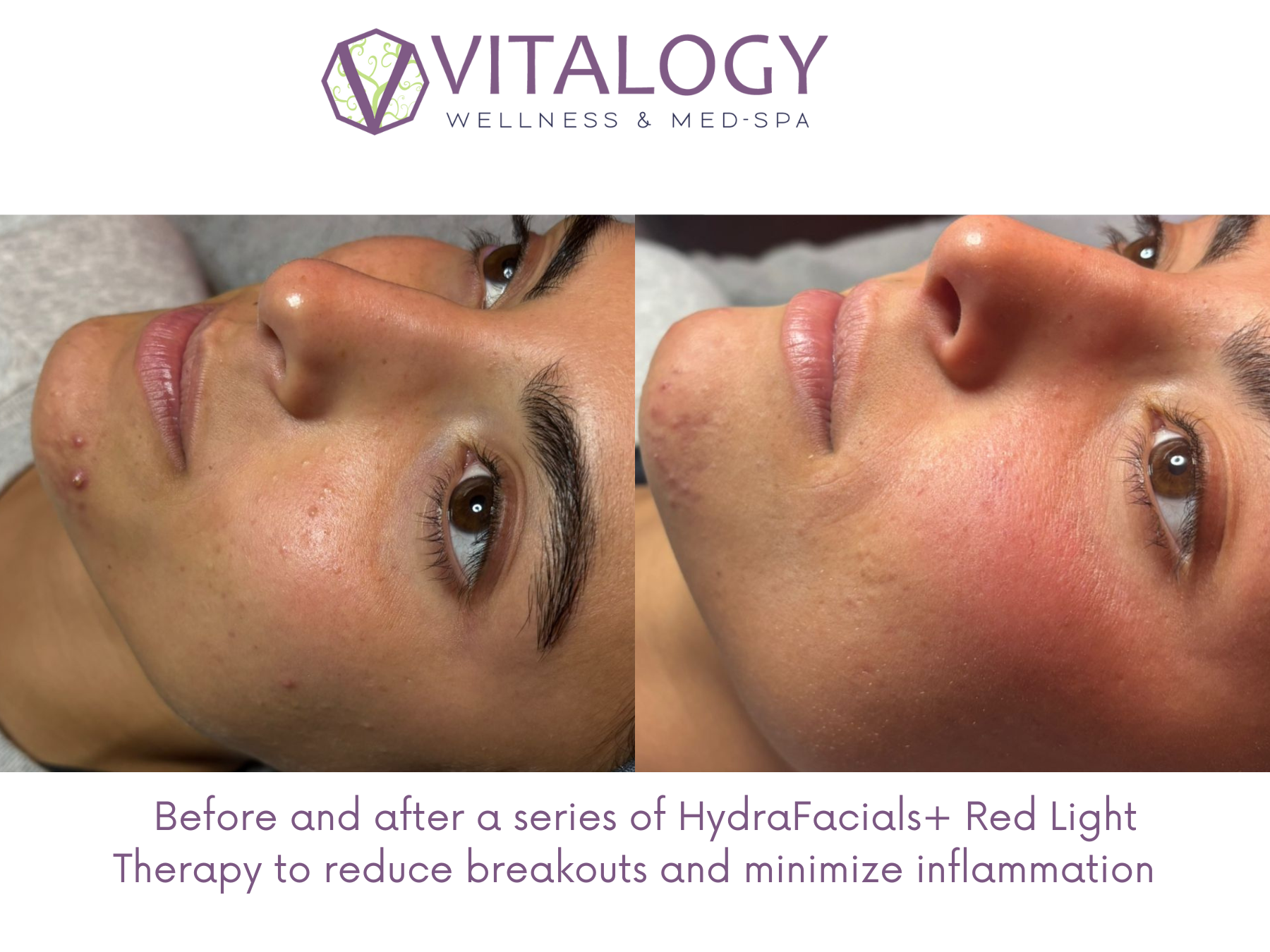 Before and after HydraFacial and Red Light Therapy
