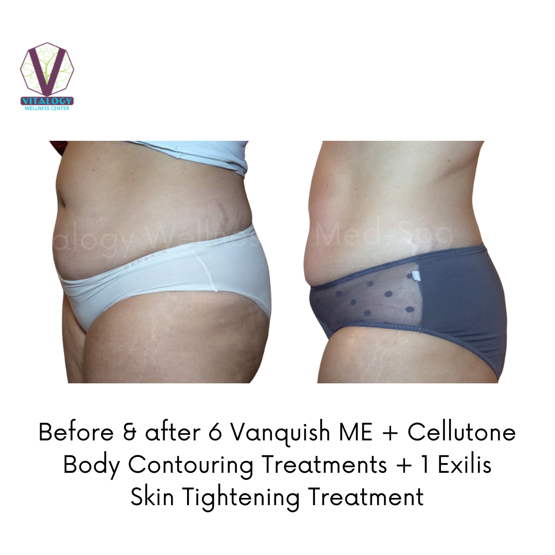 Before and after 6 Vanquish + Cellutone treatments and one Exilis treatment