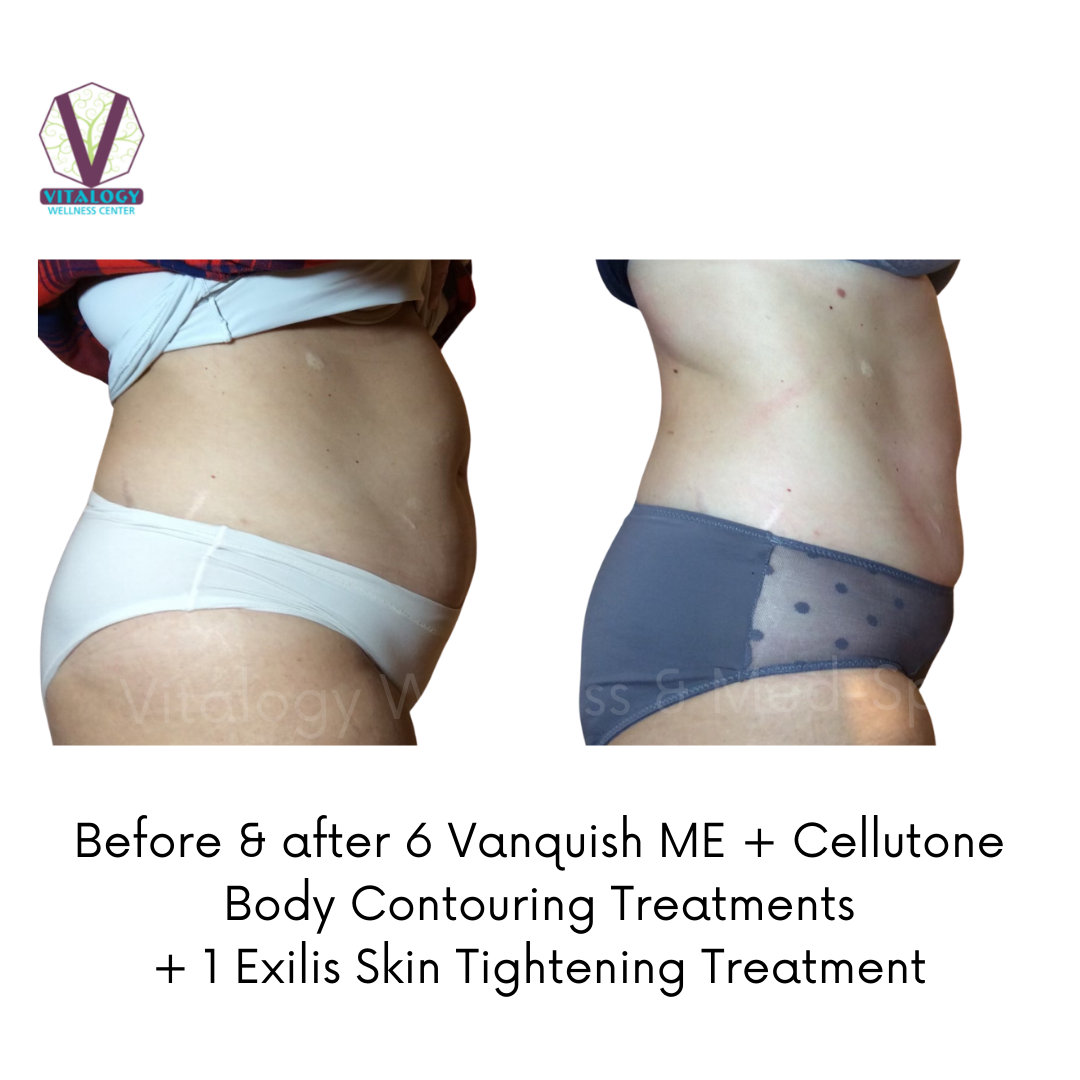 Before and after 6 Vanquish + Cellutone treatments and one Exilis treatment