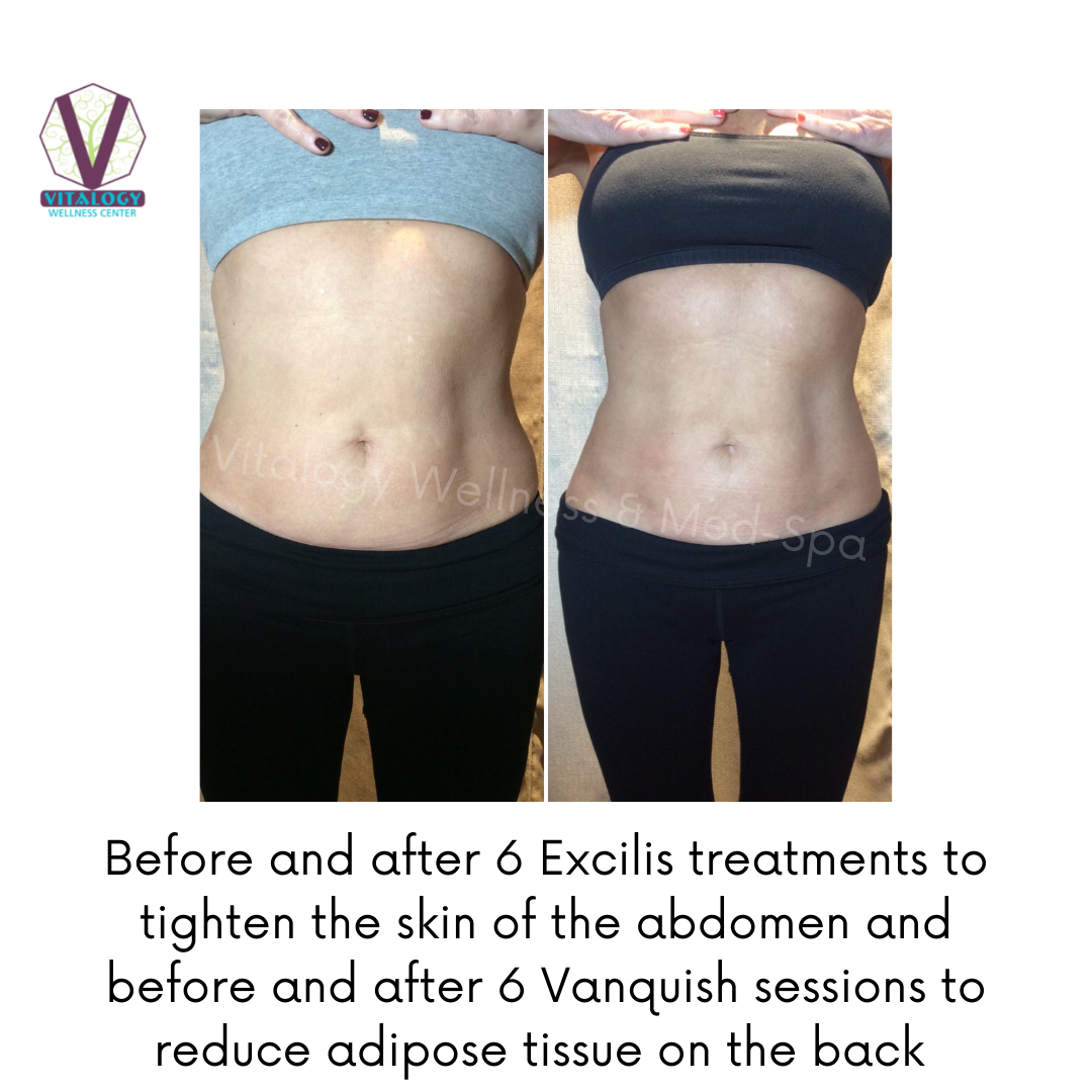 Excilis and Vanquish Before & After