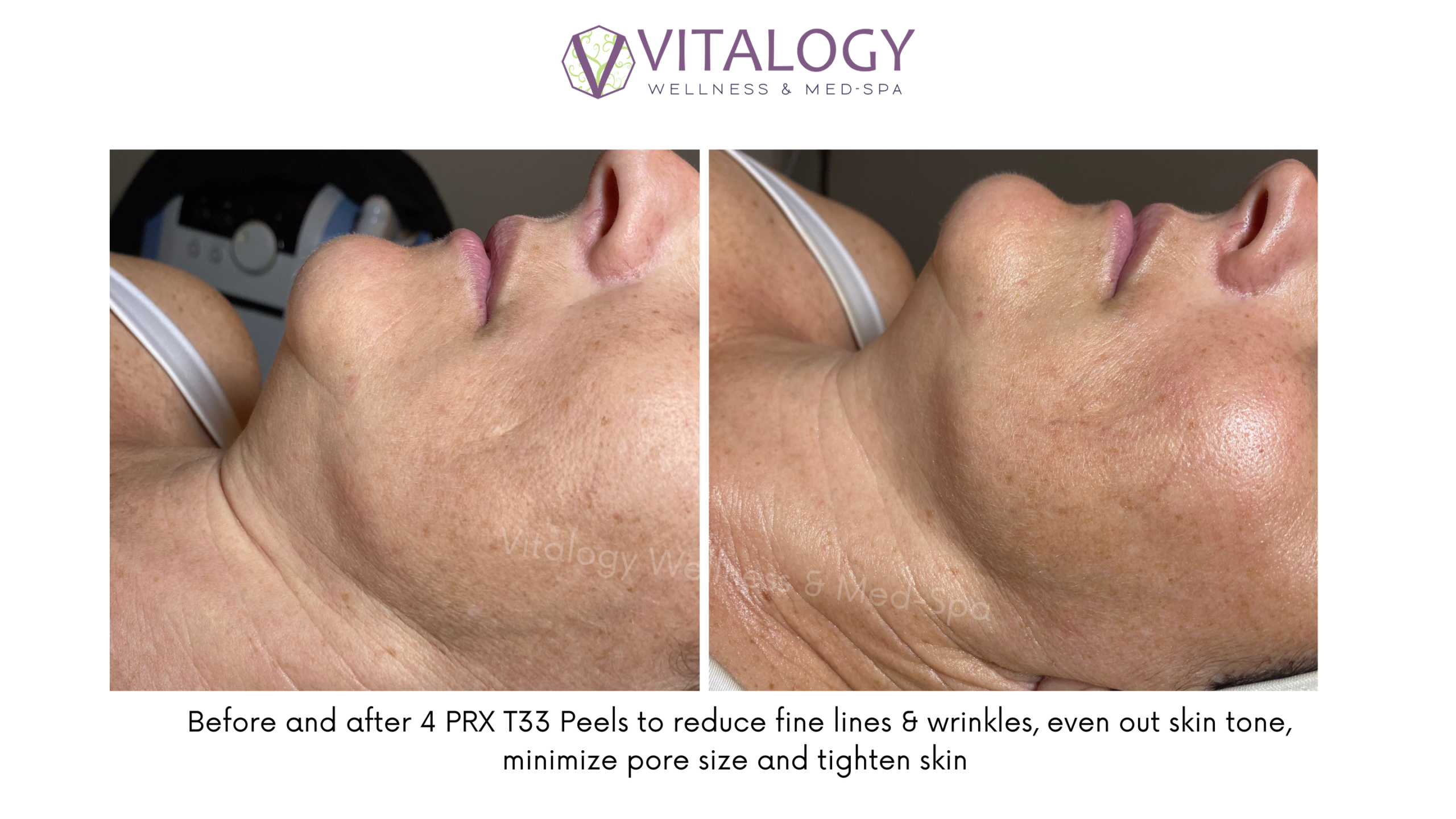Before and after 4 PRX T33 Peels