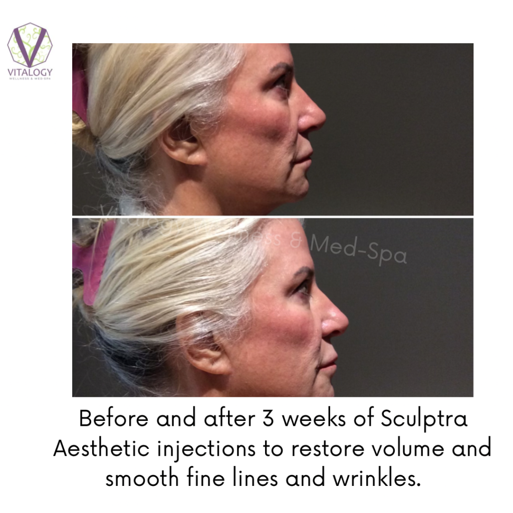 Sculptra Hip Dip Correction — PLUMP MEDICAL SPA