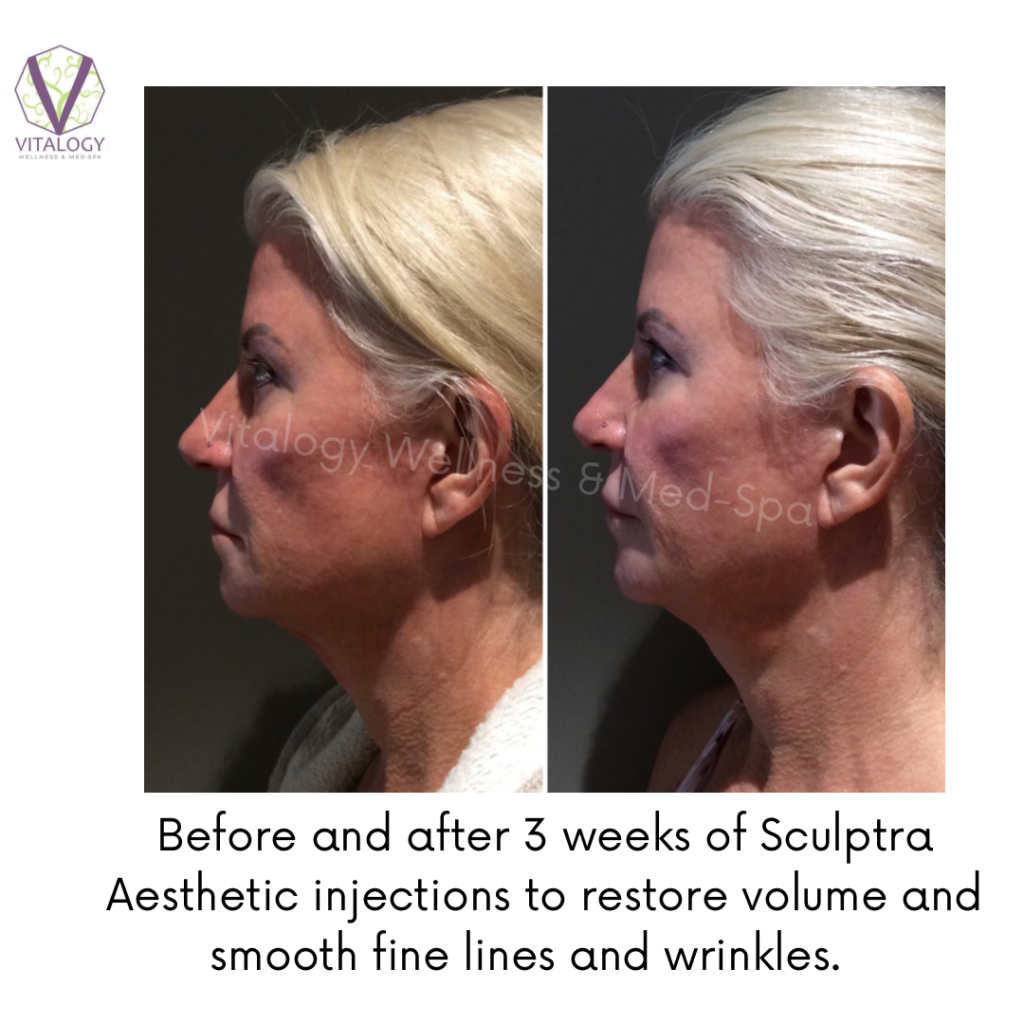 Sculptra Hip Dip Correction — PLUMP MEDICAL SPA