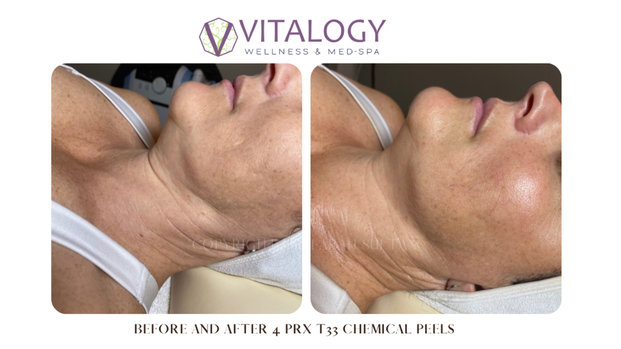 Biorevitalization Chemical Peel No Visible Peeling No Downtime