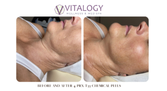 PRX T33 Biorevitalization Peel