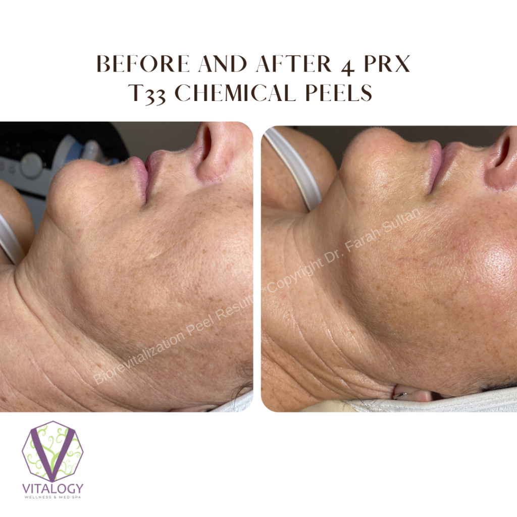 Biorevitalization Results Before and after 4 chemical peels