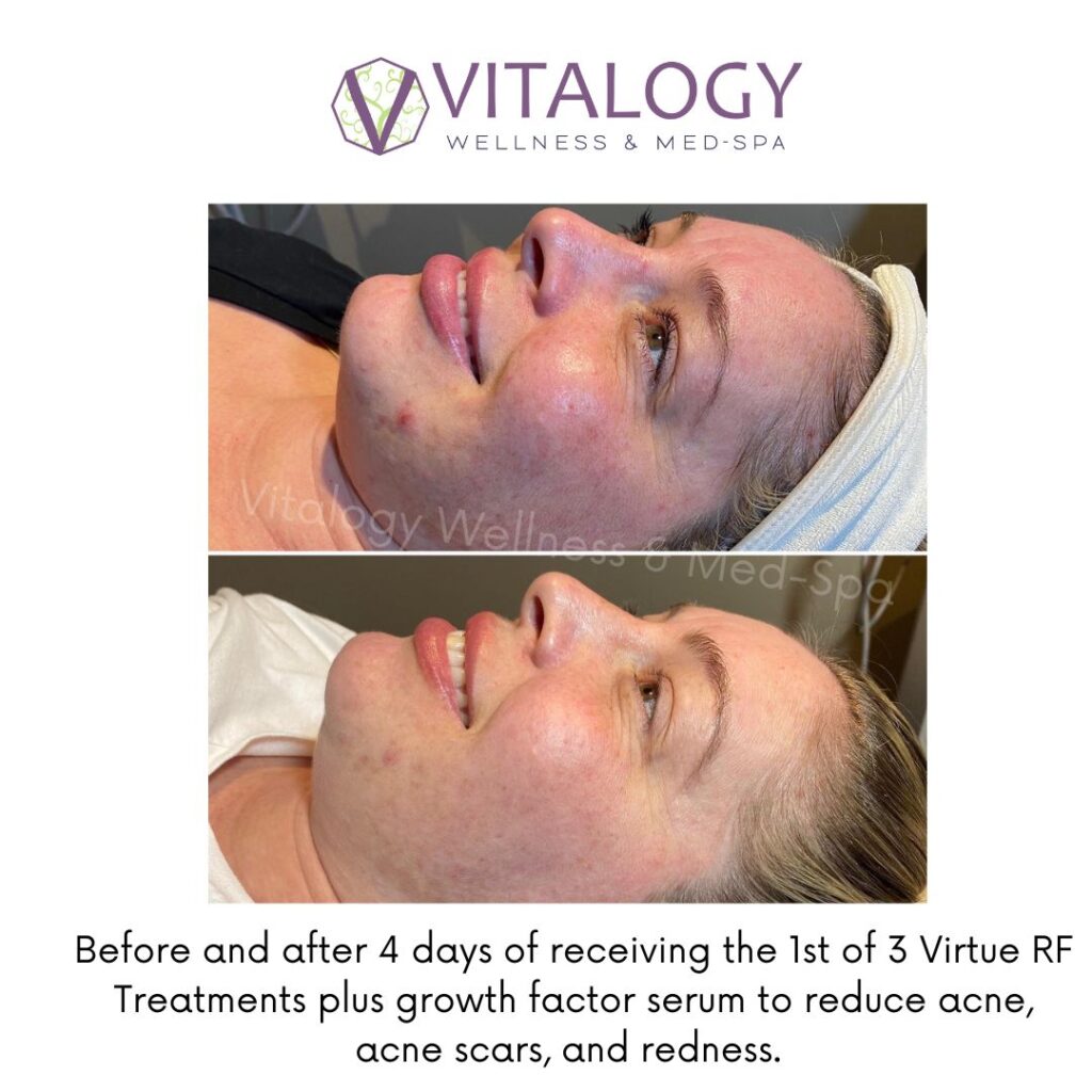 Befopre and After 4 days of receiving the 1st of 3 Virtue Rf Treatments plus growth factor serum to reduce acne, acne scars and redness