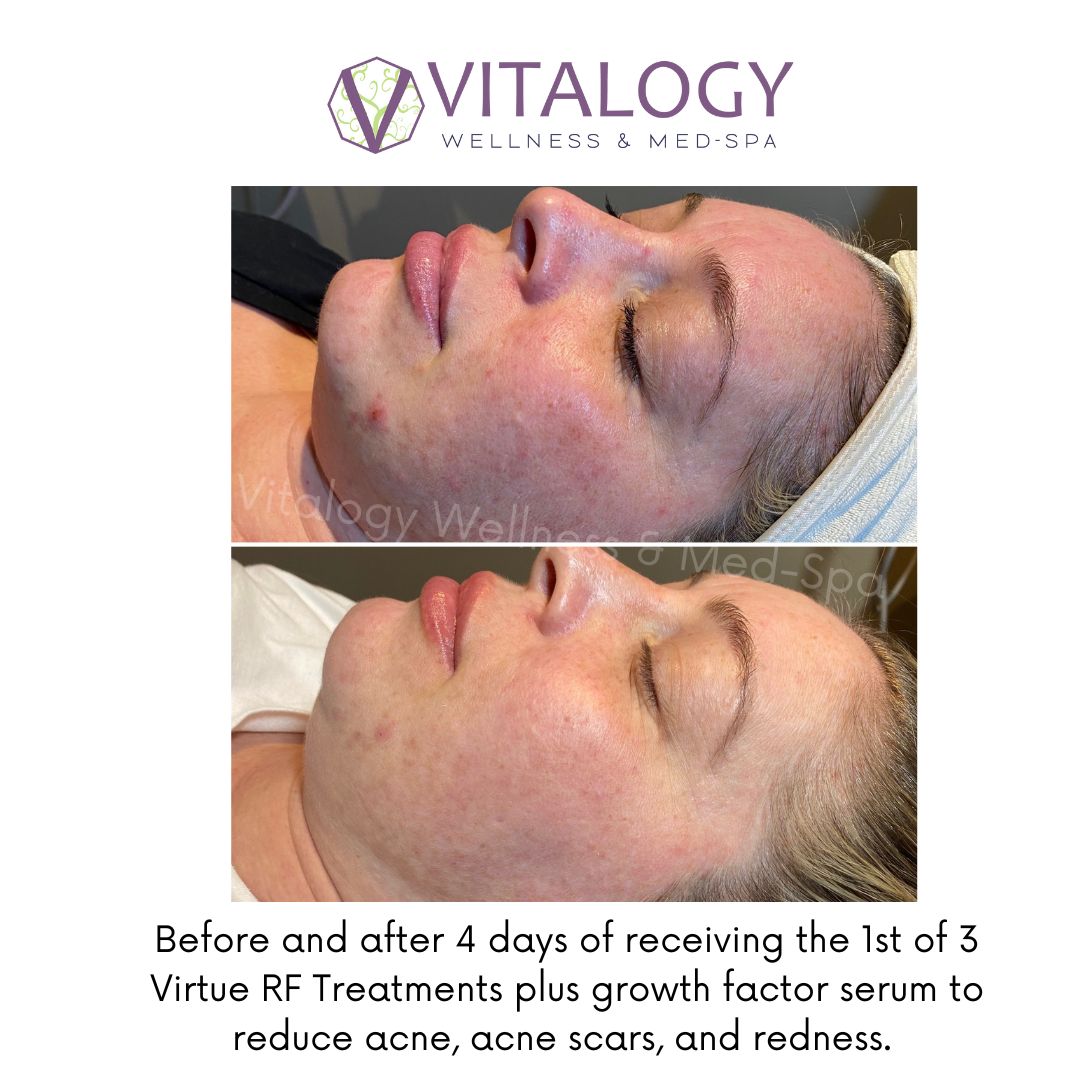 Before and After 4 days of receving the list of 3 Virtue RF Treatments plus growth factor serum to reduce acne, acne scars,and redness