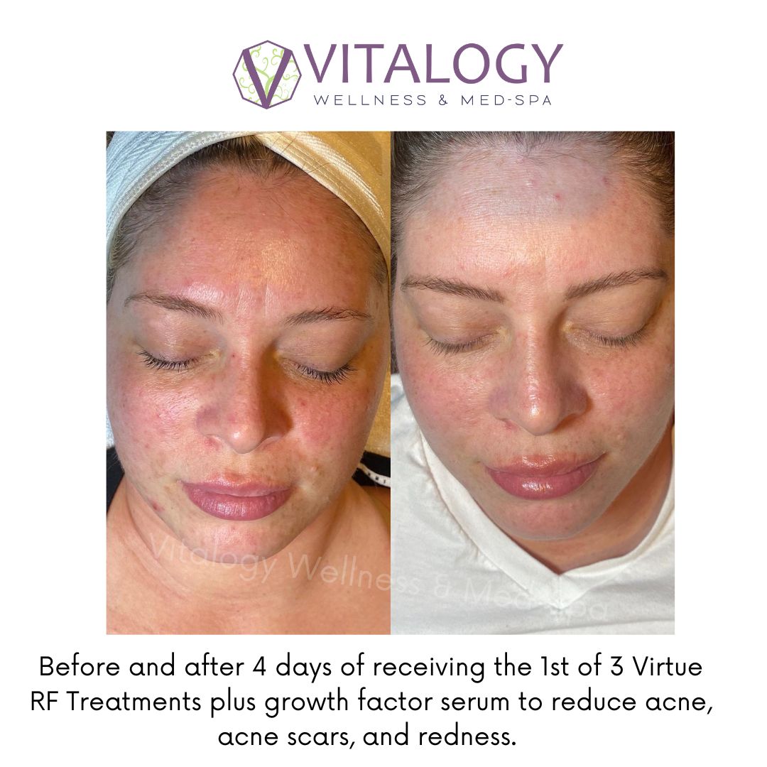 Before and After 4 days of receving the 1st of 3 Virtue RF Treatments plus growth factor serum to reduce acne,acne scars,and redness