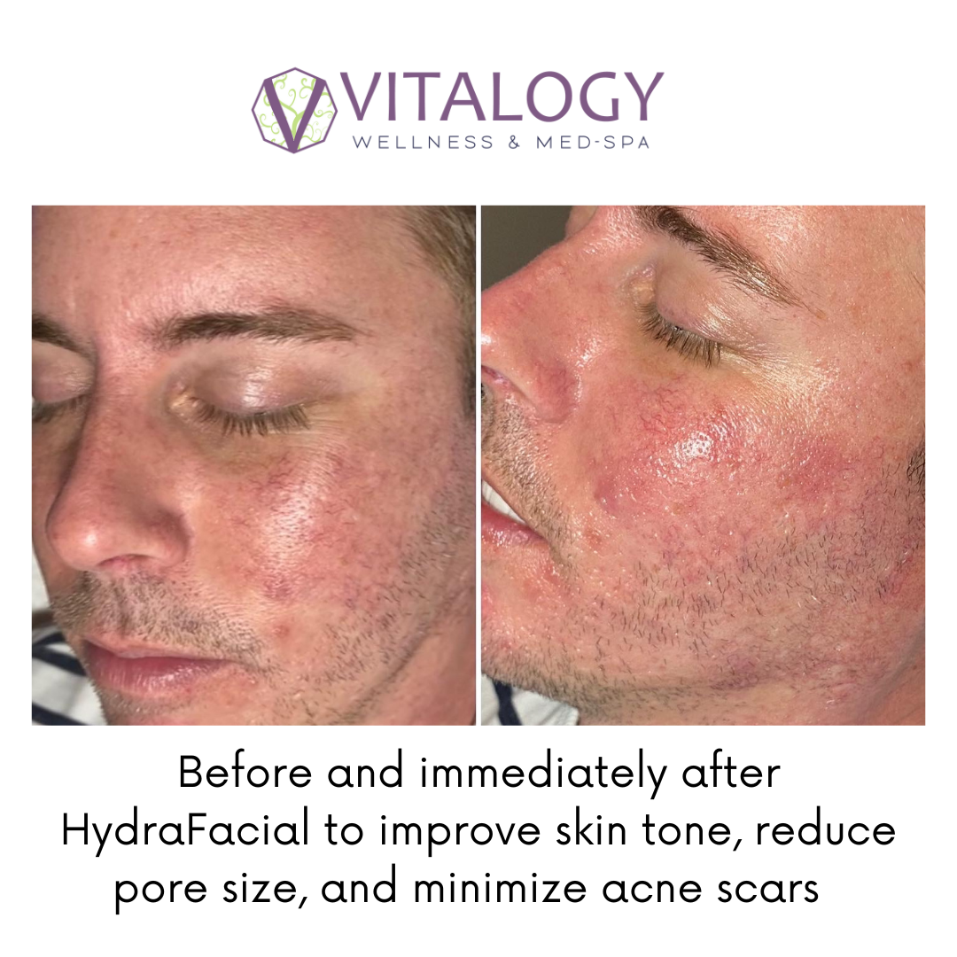 Before and After Hydrafacial