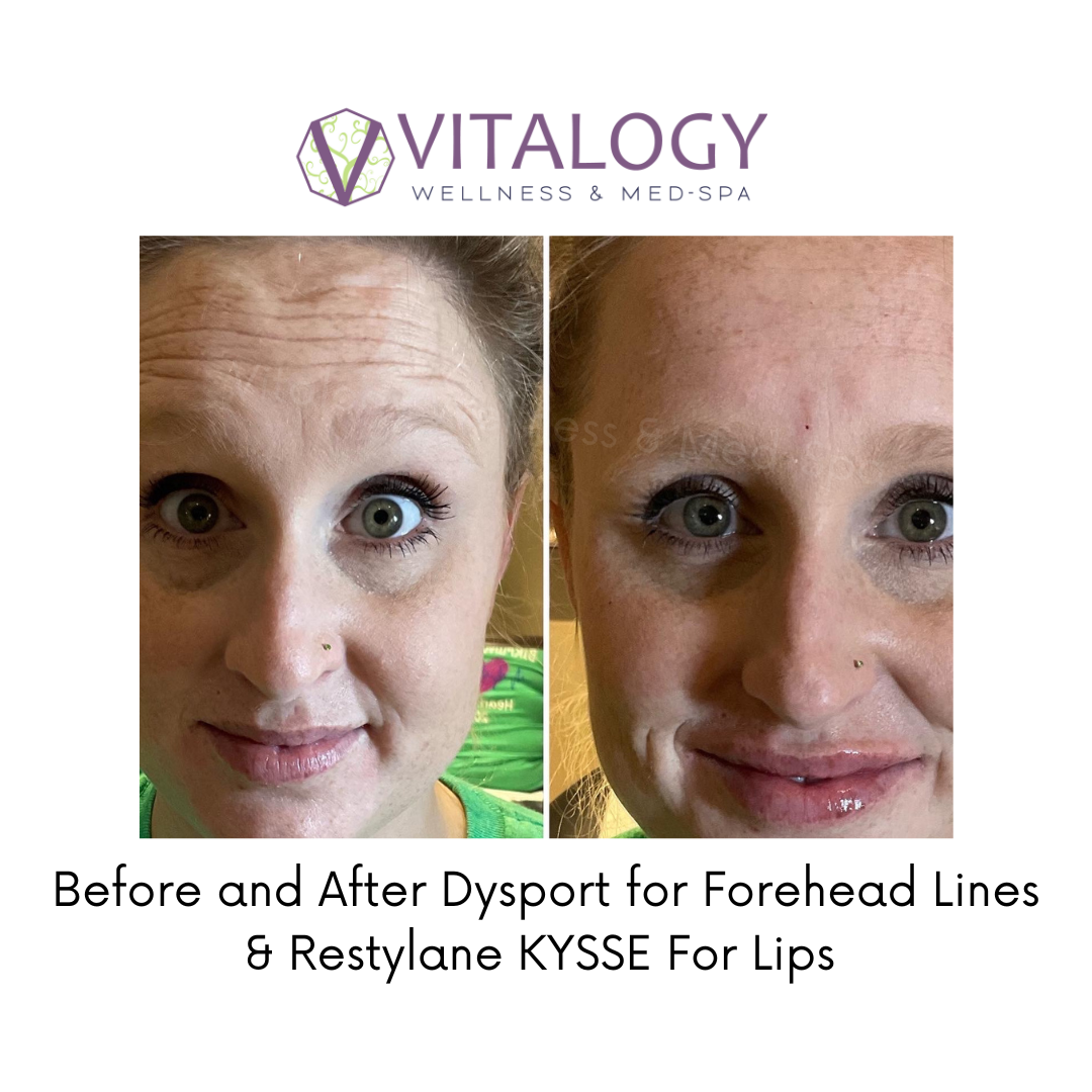 Before and after Dysport and Restylane Kysse to treat frown lines