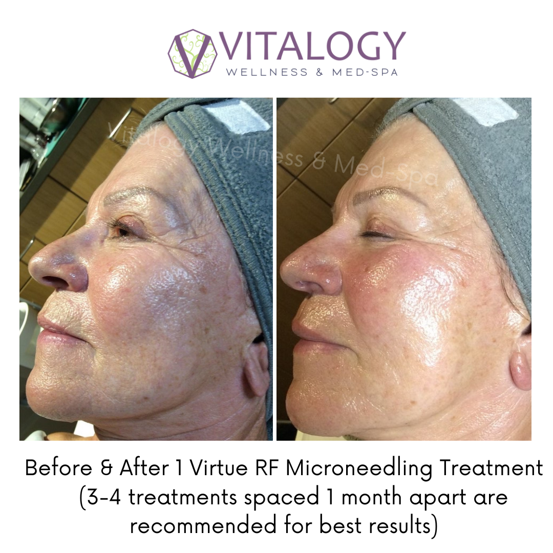Before and Immediately after 1 Virtue RF MicroneedlingTreatment ( 3-4 treatments spaced 1 month apart are recommended for best results)