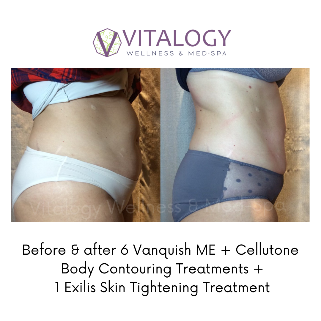 Before and after Vanquish Me and Cellutone