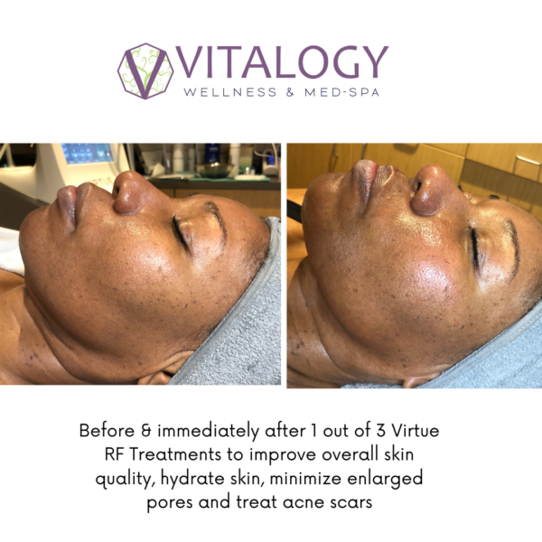 Before and after Virtue RF