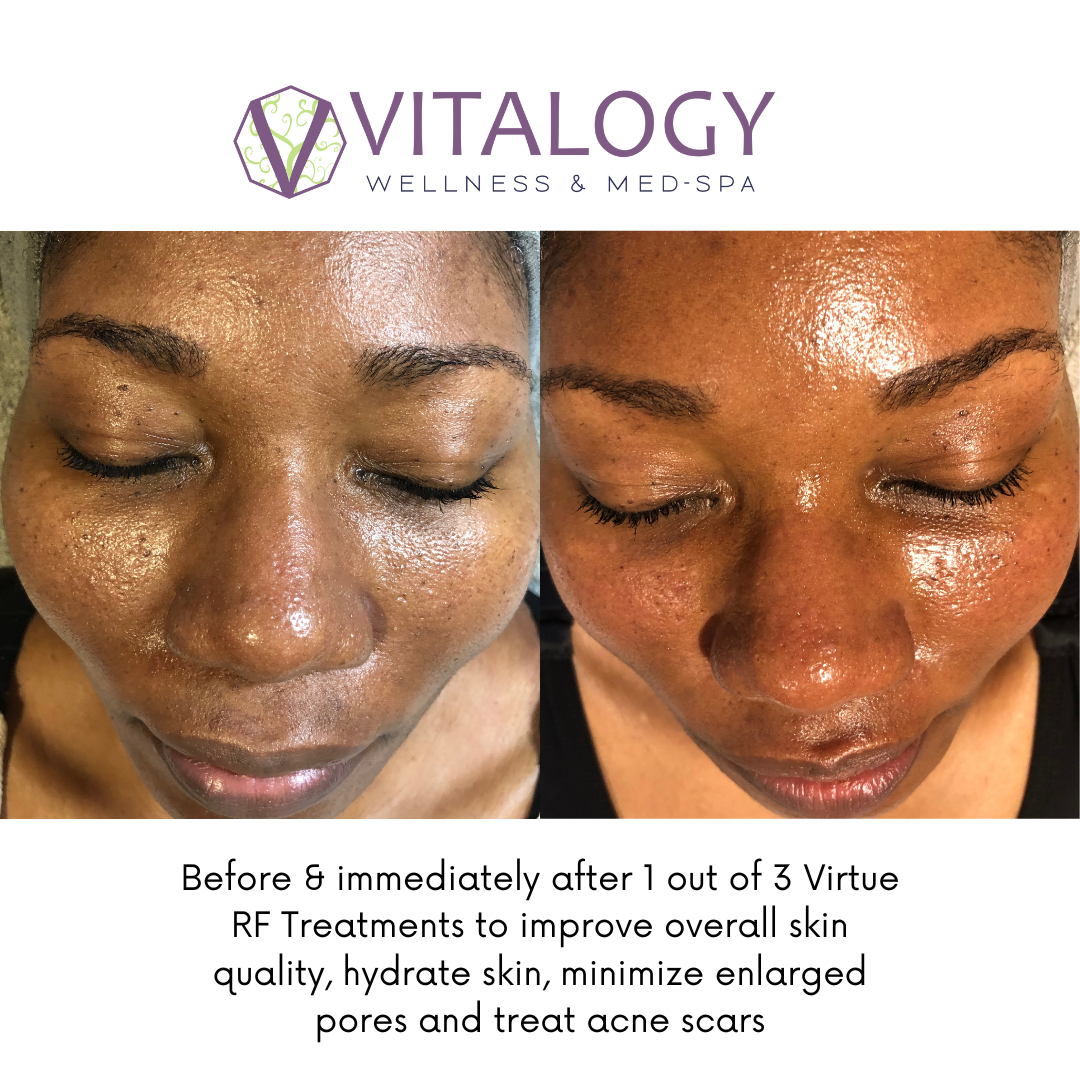 Acne scar treatment Before and after results Virtue RF Gallery