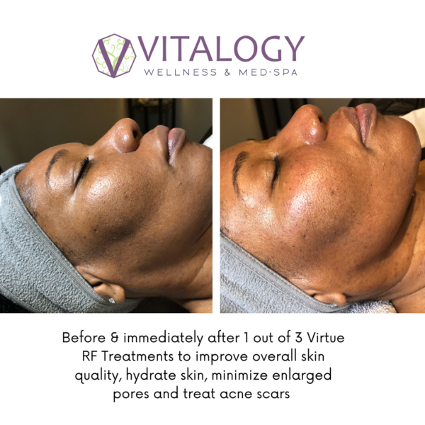 Virtue RF microneedling results