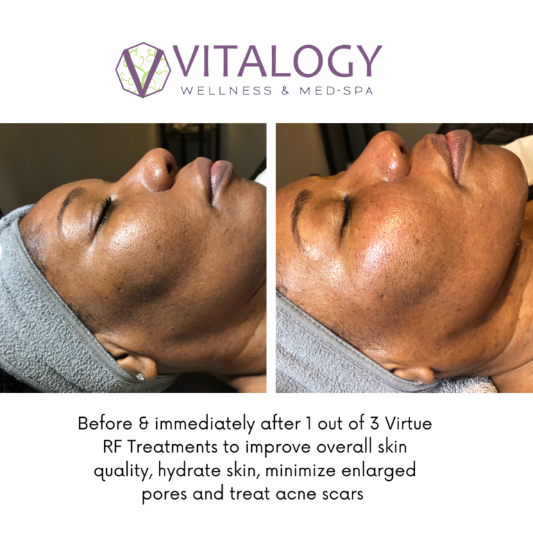 Virtue RF Microneedling