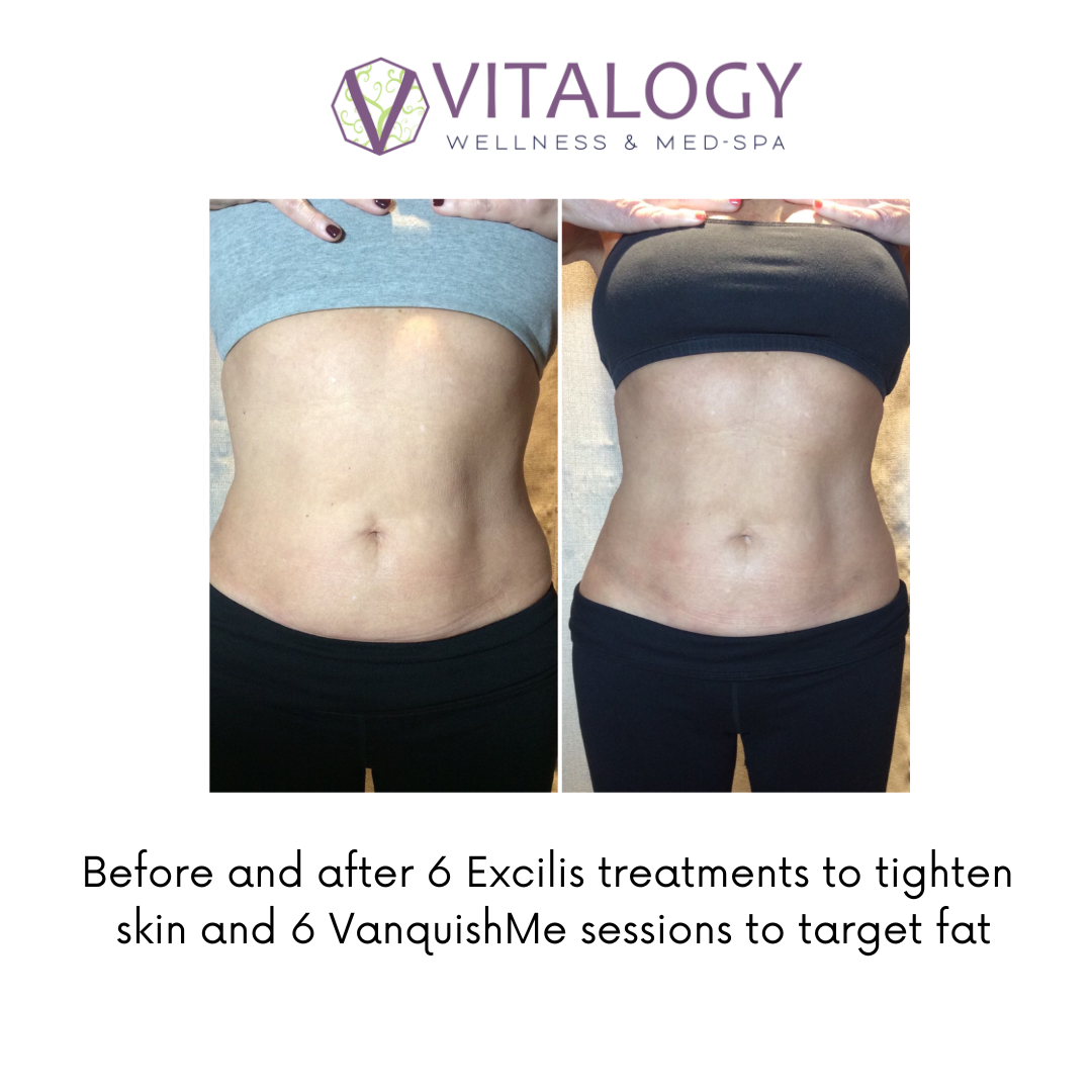 Before and after Excilis & Vanquish Body Contouring-  By Dr. Farah Sultan at Vitalogy Wellness & Medical Spa in Homewood, Alabama (4)