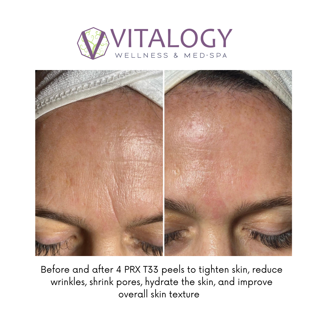 Before and after 4 PRX Dermperexion treatments formerly PRX T33 peels