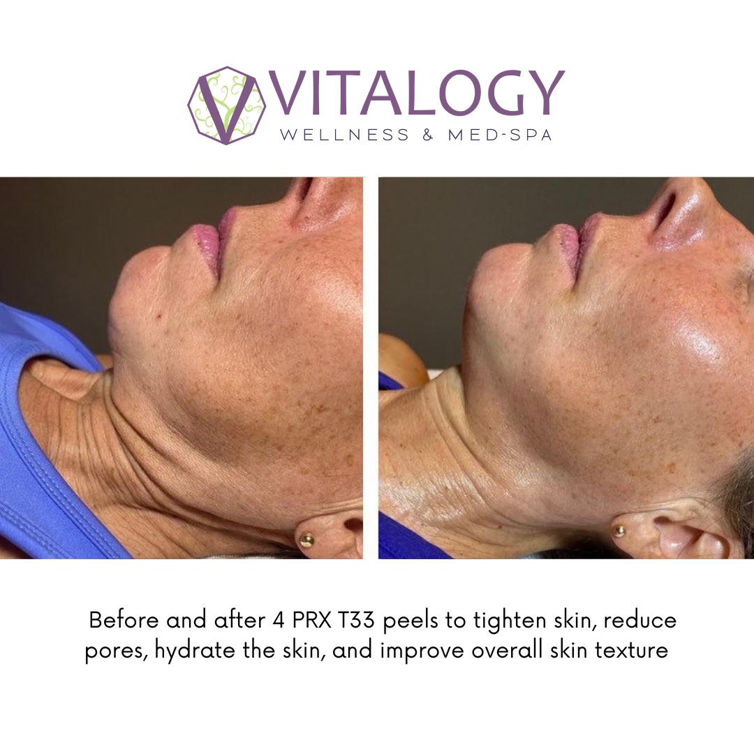 Before and after 4 PRX Dermperfexion peels -formerly PRX T33