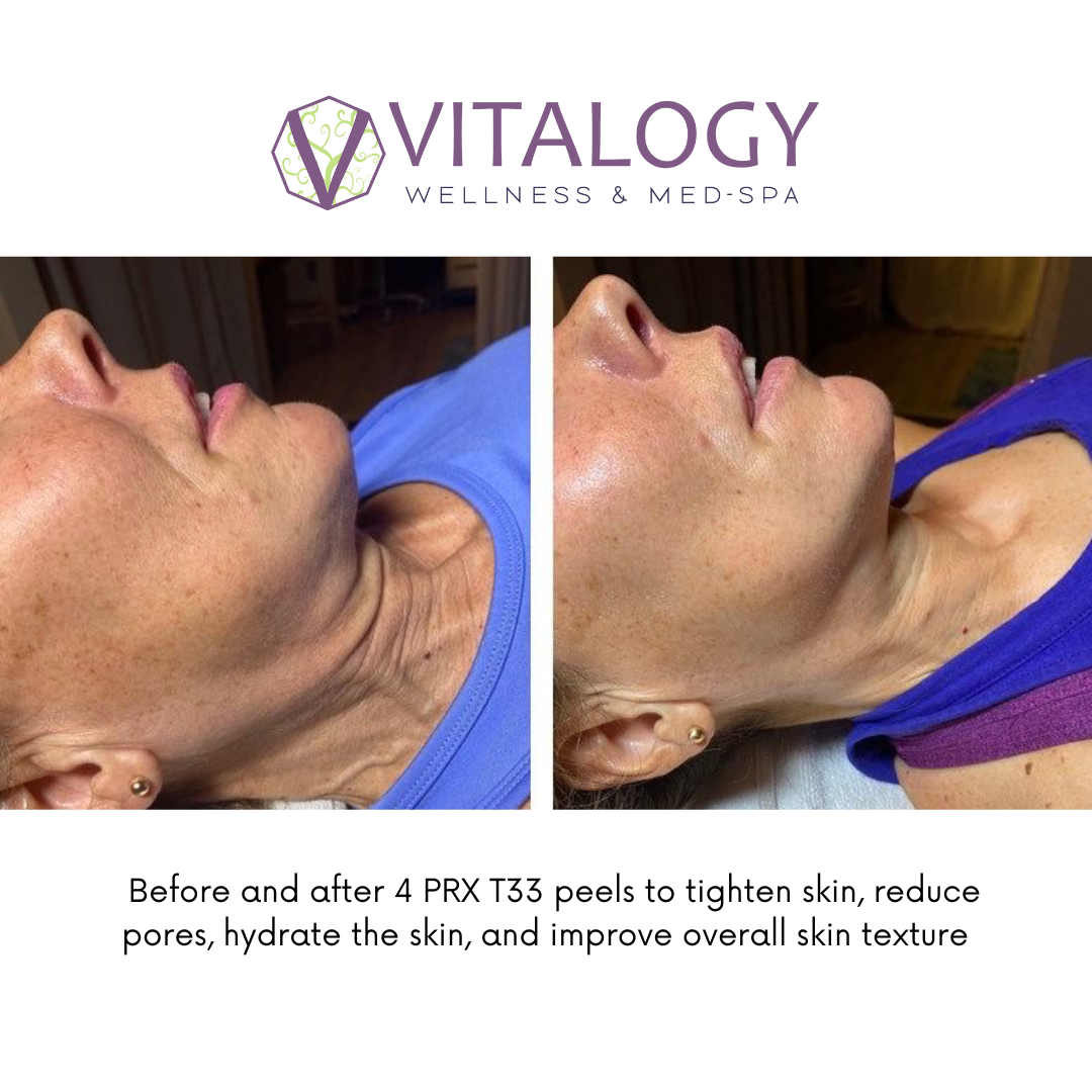 Before and after 4 PRX Dermperfexion peels -PRX T33 Peels