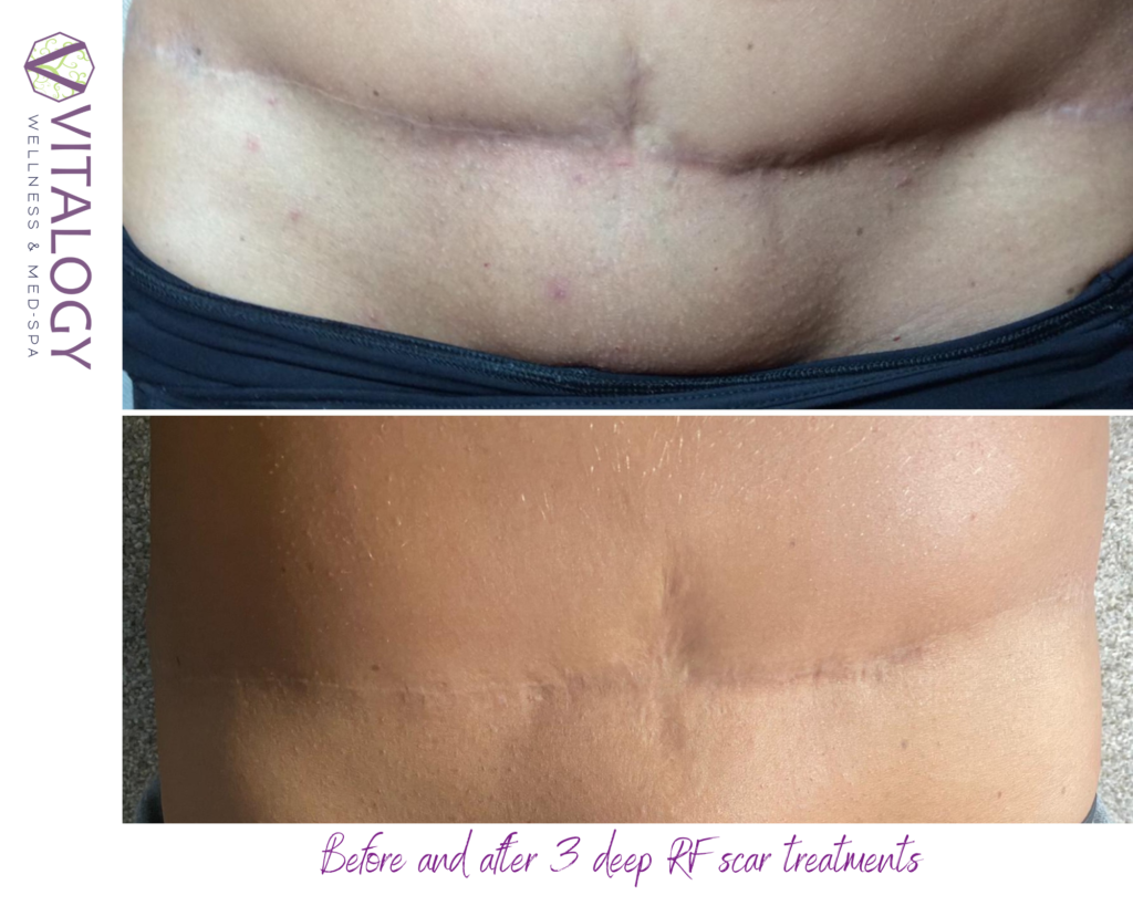 Before and after 3 scar treatments using Deep RF by Virtue RF