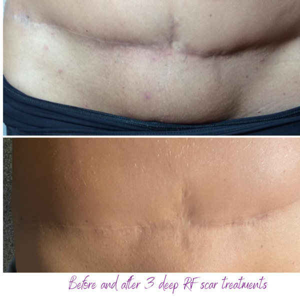 Before and after 3 scar treatments using Deep RF by Virtue RF