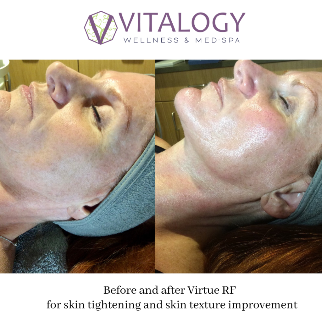 Before and After Virtue RF for Skin tightening and skin texture improvement