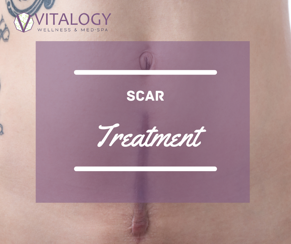 Scar Treatment at Vitalogy Wellness and Med Spa