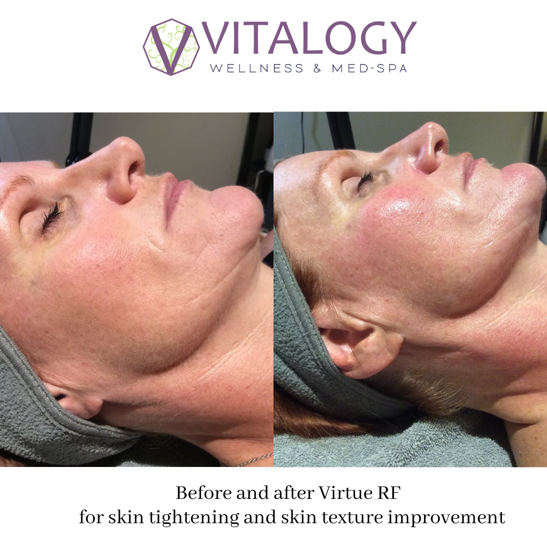 Before and After Virtue RF for Skin tightening and skin texture improvement