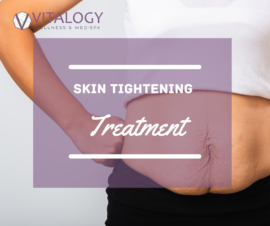 Skin Tightening Treatment at Vitalogy Wellness and Med Spa