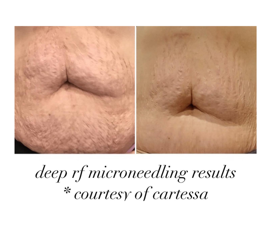 Deep RF Microneedling is perfect for skin tightening stretchmarks and scars