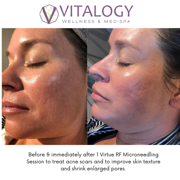 Before and after Acne Scar Treatment with Virtue RF Microneedling