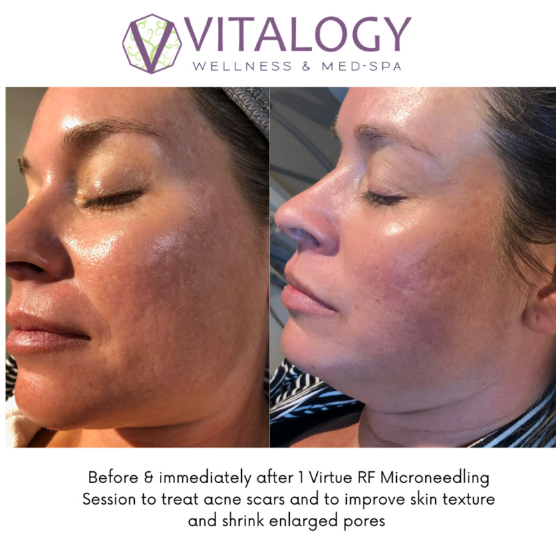 Before and after Acne Scar Treatment with Virtue RF Microneedling