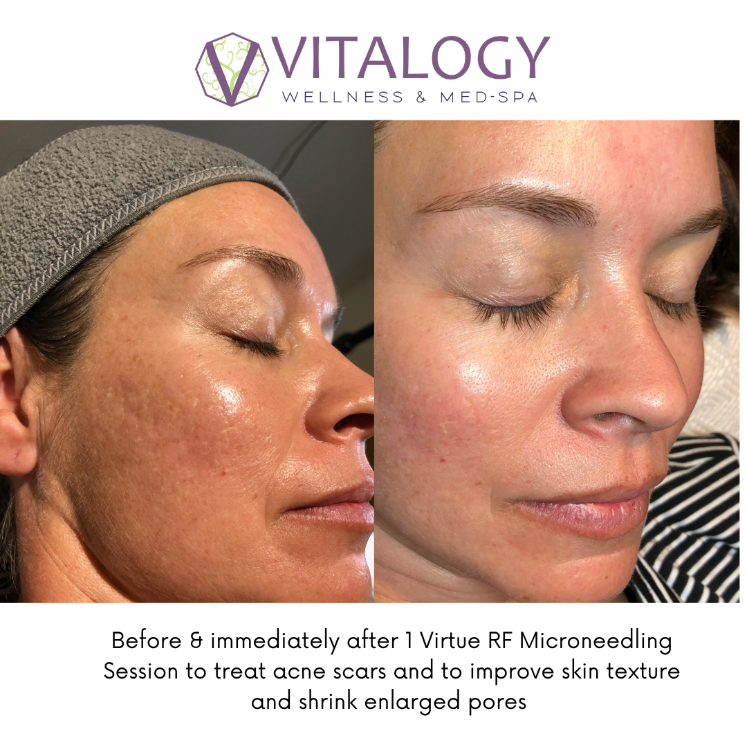 Before and after virtue Rf microneedling