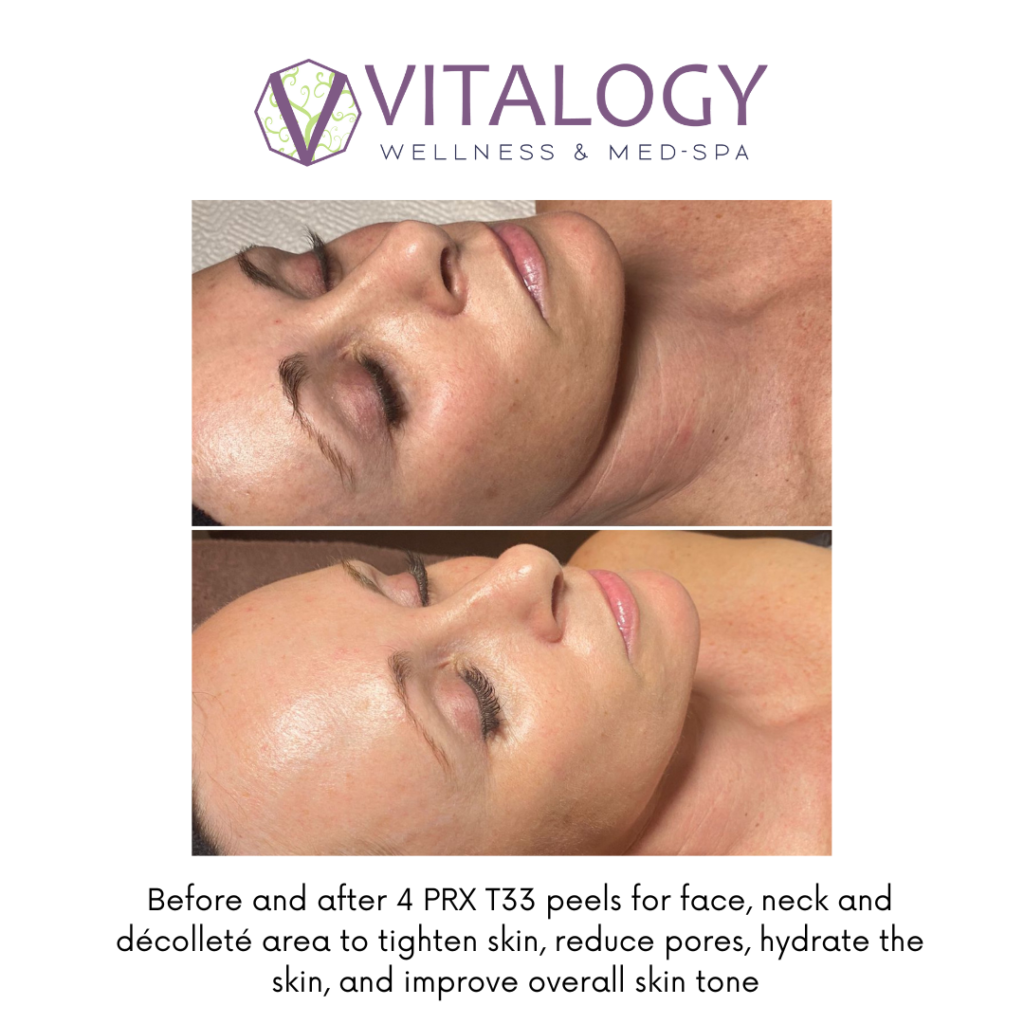 Gallery, Before & After Images, Vitalogy Med-Spa