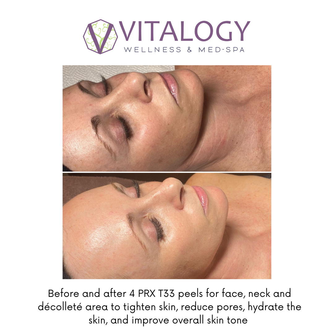 PRX DermPerfexion Treatment 4 sessions before and after image