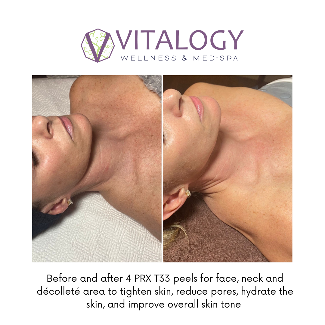 PRX DermPerfexion Treatment 4 sessions before and after image