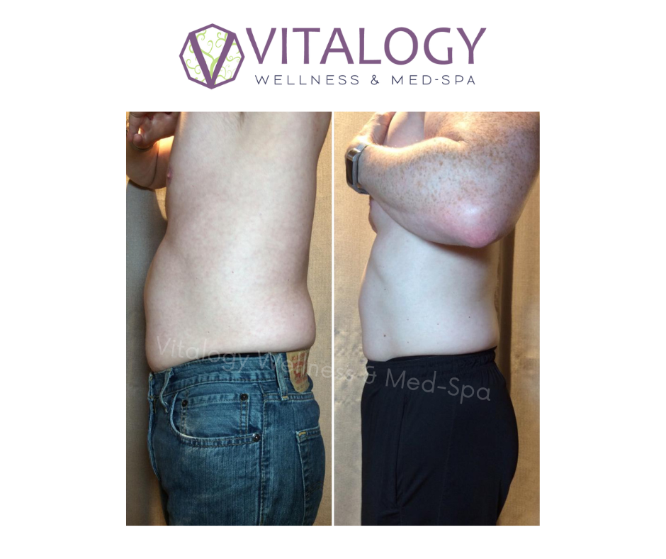 Before and After before and after Vanquish and Cellutone