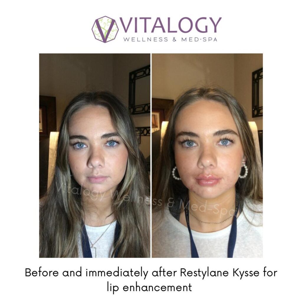 Gallery, Before & After Images, Vitalogy Med-Spa