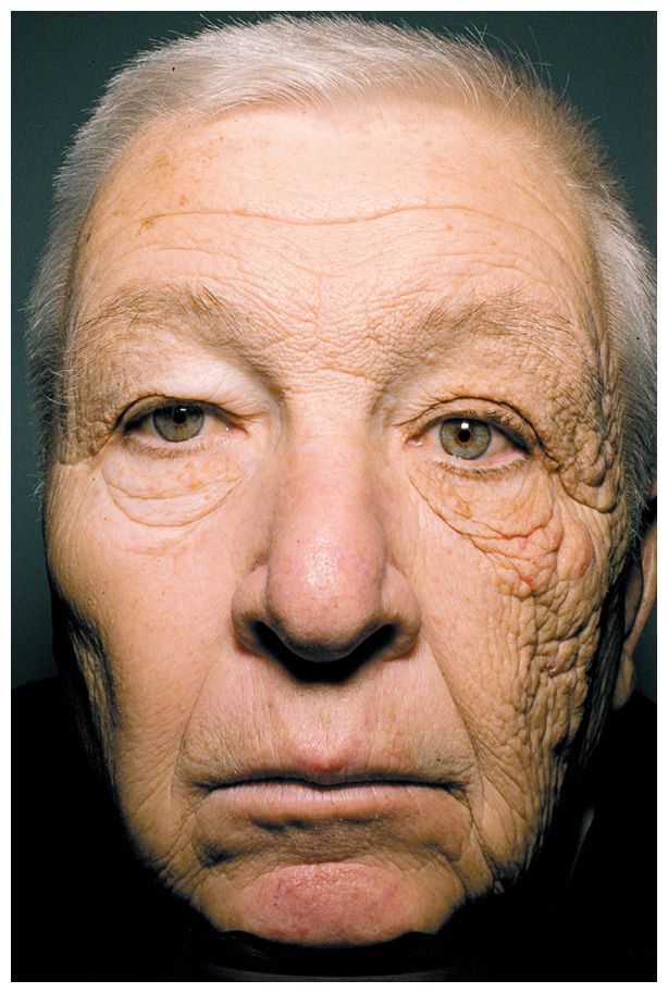 69-year-old patient left side of face condition due to constant exposure to UV Rays without sunscreen .