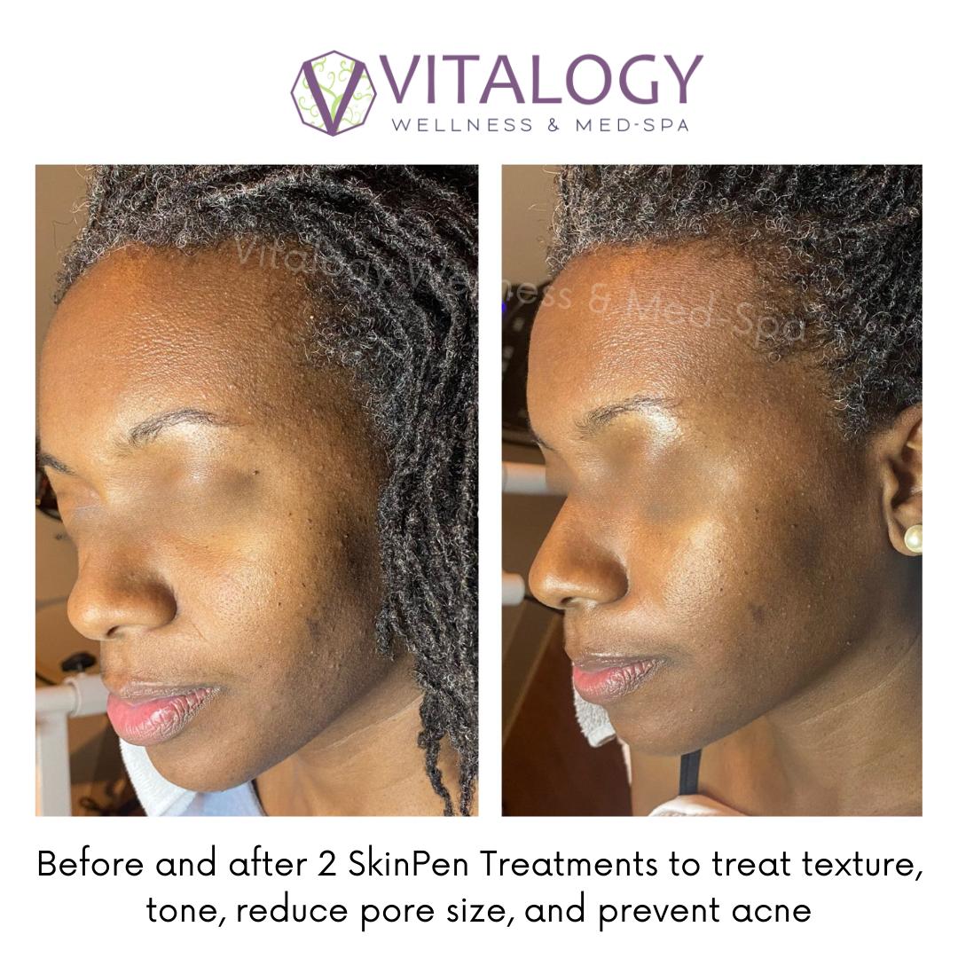 Before and after SkinPen Treatments results - Vitalogy Wellness and Med Spa